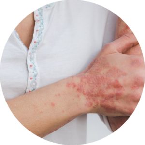 Best Eczema Skin Treatment in Hosur